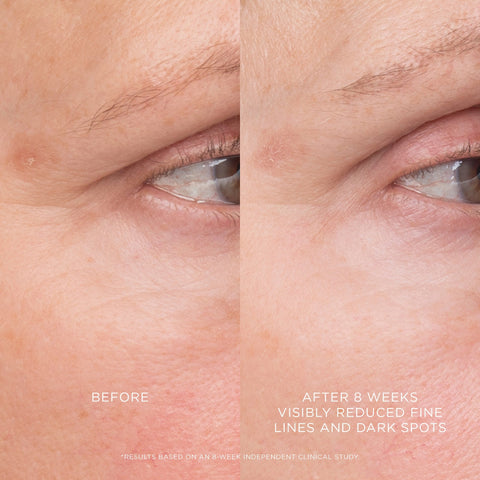 Equilibrium Resurfacing Retinoid Treatment